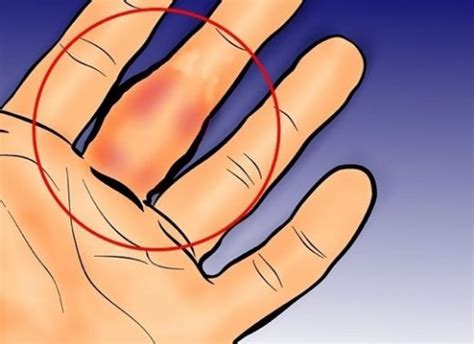 orta parmakta şişlik ve ağrı